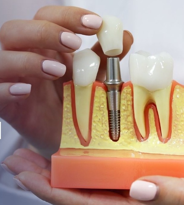 Modelo de implante dentário sendo apresentado pela equipe